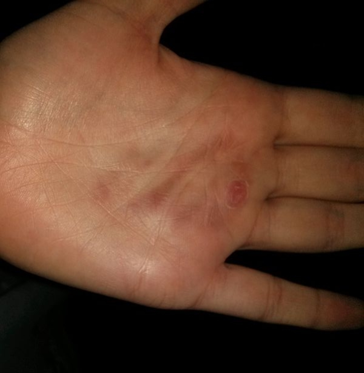 Scarring as a result of the salt and ice challenge